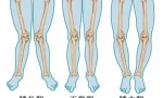 什么是小儿O形腿和X形腿（教你矫正儿童x型腿）缩略图