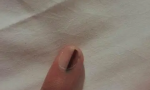 为什么指甲会出现竖纹黑线（科学认识指甲的黑线问题）缩略图