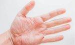 手脱皮是缺什么维生素（分享有效缓解的方法）缩略图