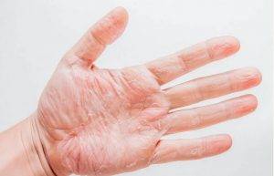 手脱皮是缺什么维生素（分享有效缓解的方法）缩略图