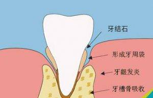 牙结石有哪些形成原因（教你如何预防牙结石）缩略图